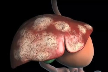 Исследователи определили, как клетки печени дегенерируют и вызывают рак печени