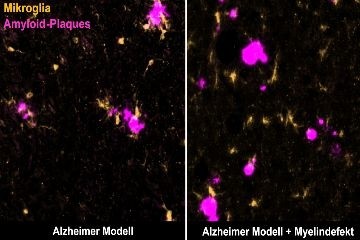 Стареющий изоляционный слой нервов способствует развитию болезни Альцгеймера