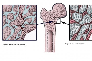 В чем причины остеопороза?