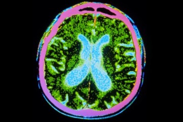 Вирус учатся использовать для «перепрошивки» мозга при болезни Паркинсона