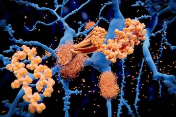 Антитела распознают бляшки при болезни Альцгеймера