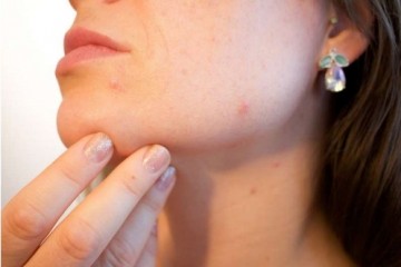 Ученые обнаружили у вызывающей угри бактерии штаммы, которые улучшают кожу
