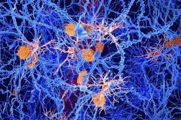 При болезни Альцгеймера бета-амилоидные бляшки жарят нейроны головного мозга как яйца 