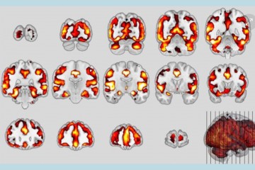 В мозге найдено сходство деменции и шизофрении
