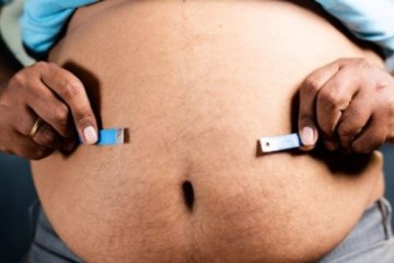 Исследователи обнаружили два подтипа ожирения