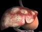 Исследователи определили, как клетки печени дегенерируют и вызывают рак печени